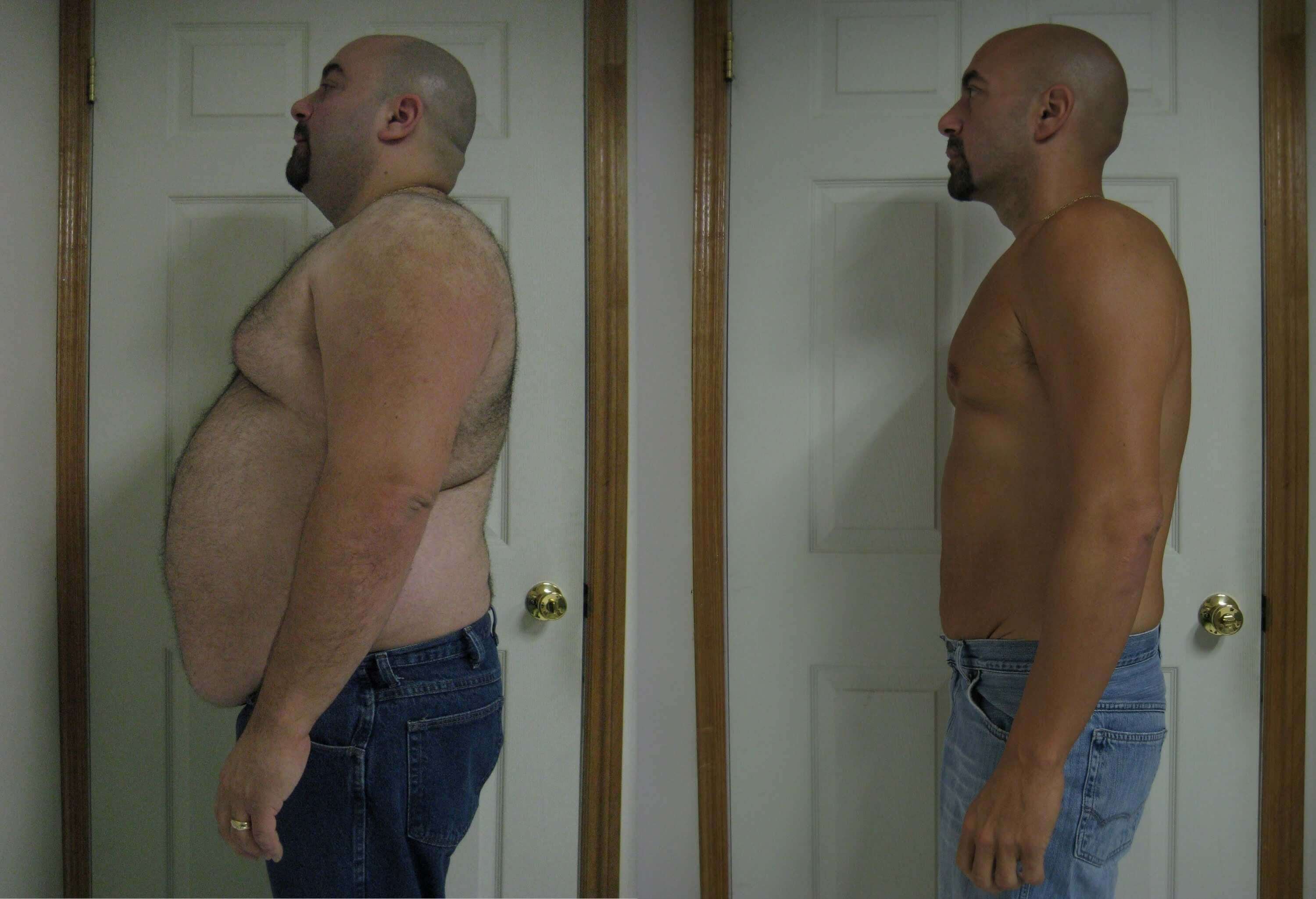 gastric bypass before and after man 1