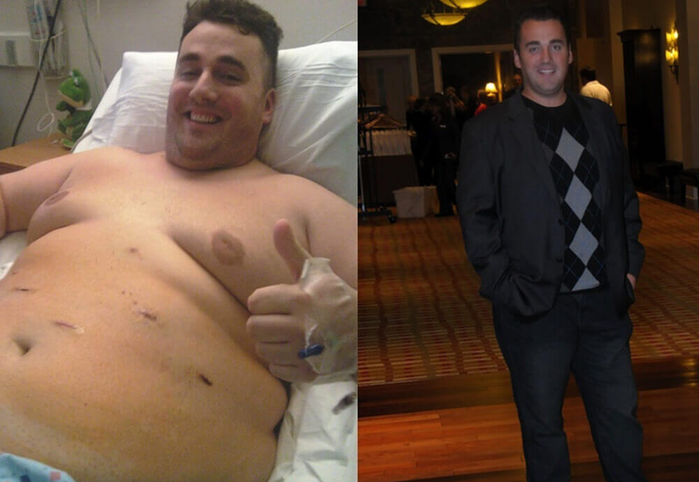 gastric bypass before and after man 4