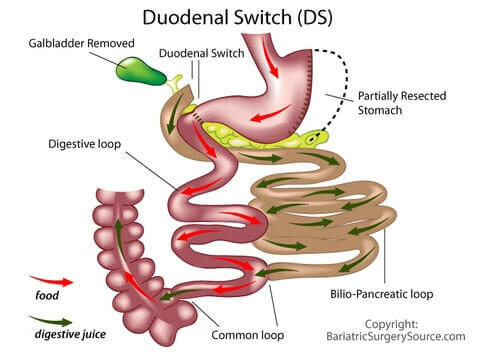 duodenal switch surgery bariatric weight loss bpd ds types after affect diversion biliopancreatic source type each diet dr therapy stomach