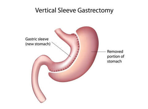 Average Weight Loss With Gastric Sleeve Per Month