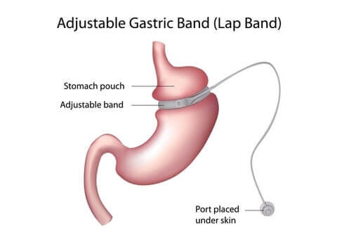 gastric Lap-band procedure