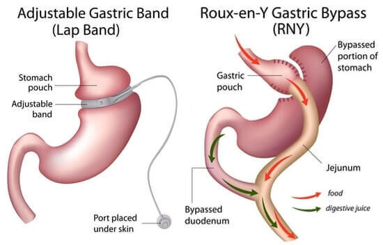 Gastric bypass surgery lowers women's alcohol tolerance