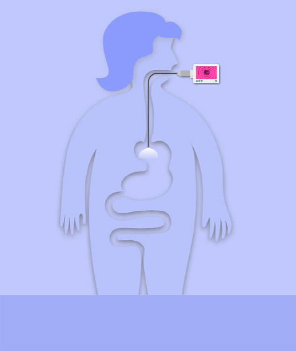 Gastric Balloon All You Need to Know Bariatric Surgery Source