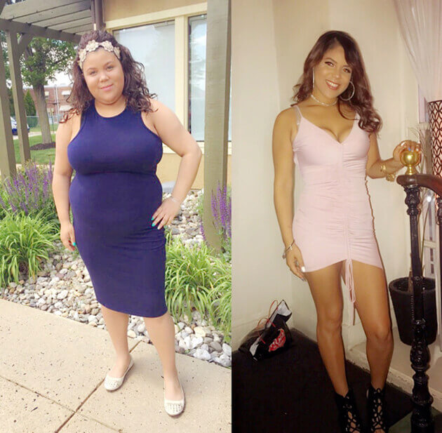 Gastric Sleeve Story