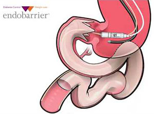 Experimental Weight Loss Surgery