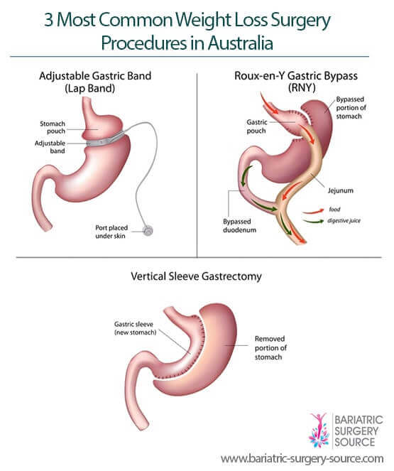 weight loss surgery australia