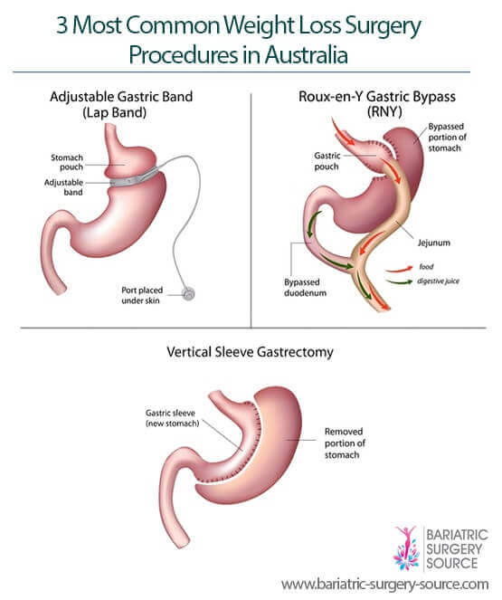 Weight Loss Surgery Comparison Chart