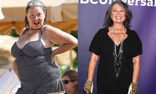 Roseanne Barr Weight Loss Surgery