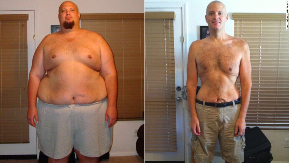 gastric bypass before and after man 3