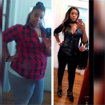Gastric Bypass Before and After women 2