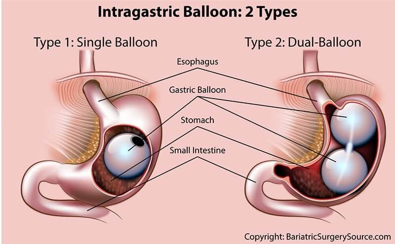 Bariatric Surgery Comparison Chart