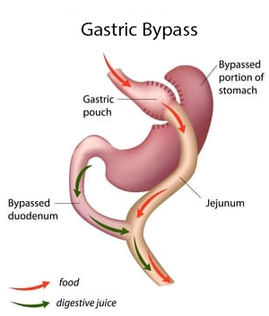 Gastric Bypass