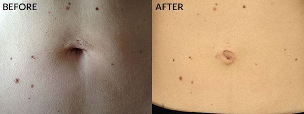 Gastric Sleeve Scars