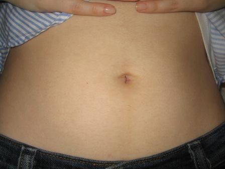 Gastric Sleeve Scars