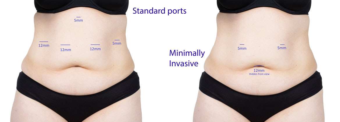 Gastric Sleeve Scars