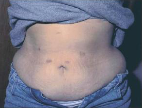 Gastric Sleeve Scars