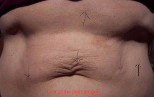 Gastric Sleeve Scars