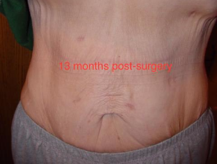 Gastric Sleeve Scars