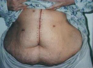 Gastric Sleeve Scars