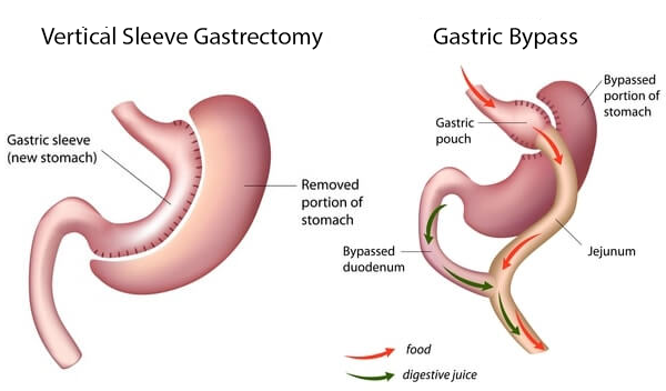 Gastric Sleeve Vs Bypass 