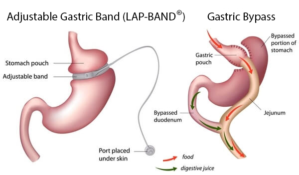Lap Band vs Gastric Bypass