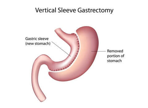 gastric sleeve surgery