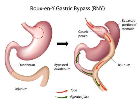 gastric bypass surgery