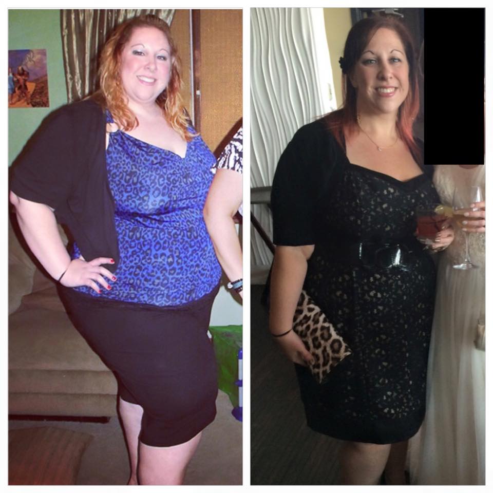 Gastric Sleeve Success Rate Picture