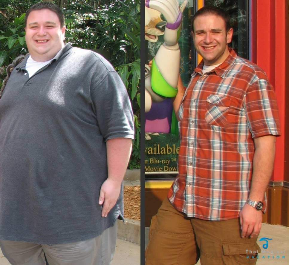 Gastric Sleeve Before after Men 2