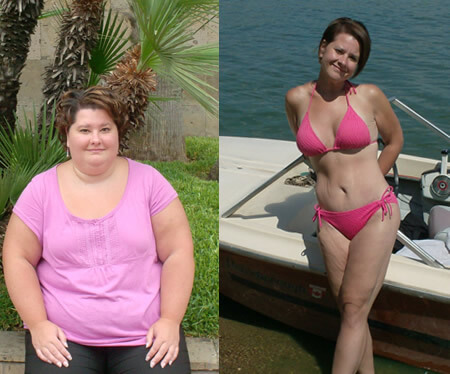 Gastric Sleeve Before after Women 1
