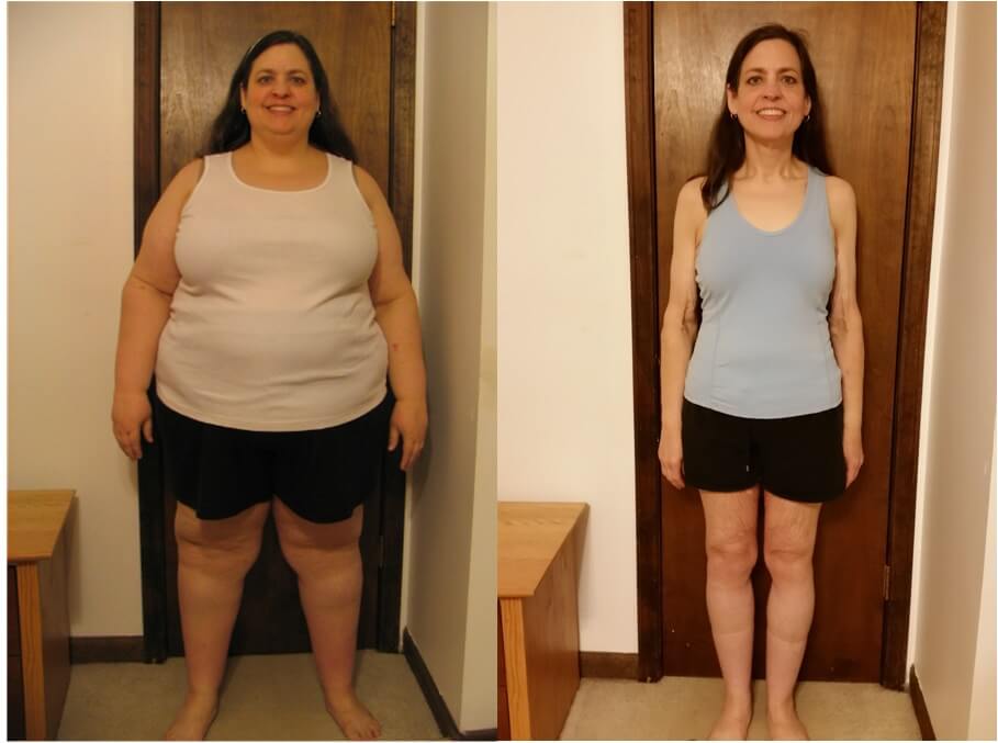 Gastric Sleeve Before And After Pictures And What You Can Expect Bariatric Surgery Source