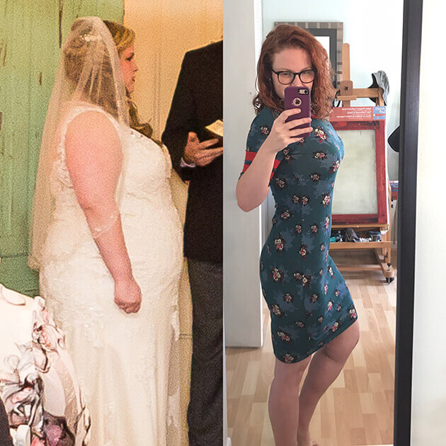 Gastric Sleeve Story