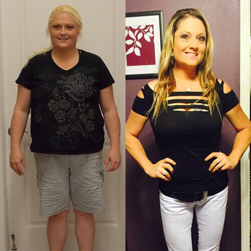 Gastric Sleeve Story