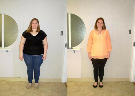 Gastric Sleeve Story