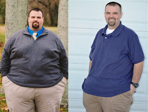 Gastric Sleeve Story