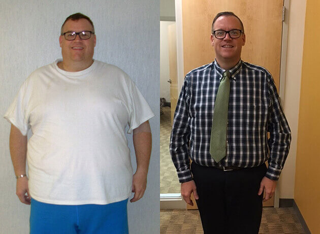 Gastric Sleeve Story