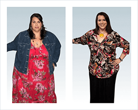 Gastric Sleeve Before after Women 3