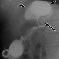 Short arrows show pouch dilatation; Large arrows show small amounts of contrast material passing through gastric band*