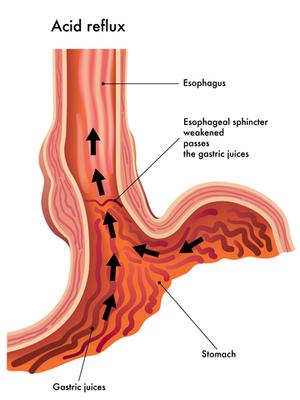 Heartburn and acid reflux after lap band surgery with no weight ...