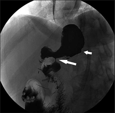 Stricture Example: This patient had undergone Roux-en-Y gastric bypass 1 year prior to presenting with nausea, vomiting, and intolerance of oral food intake. An upper gastrointestinal examination shows a severe proximal anastomotic stricture (long arrow) with dilatation of the gastric pouch (short arrow). At surgery, the stricture was found to be caused by fibrosis.*