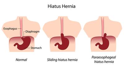 Hiatal Hernia Illustration