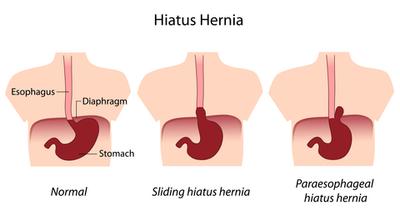 Hiatal Hernia Illustration