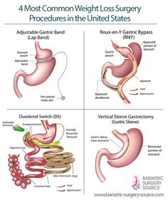 4 Common Types of Weight Loss Surgery