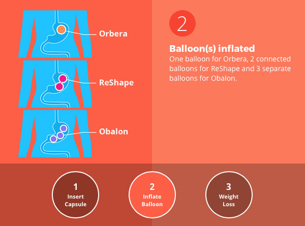 Gastric Balloon - 14 Ways It Will Affect You - Bariatric Surgery Source