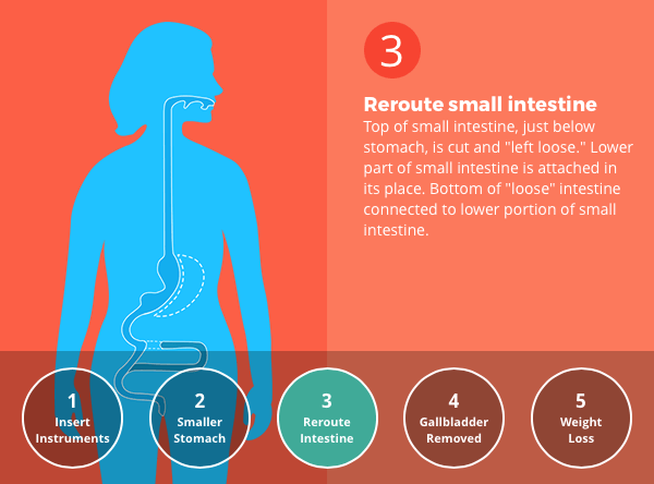 Duodenal Switch (DS) Surgery - 14 Ways It Will Affect You - Bariatric ...