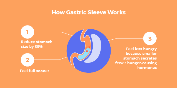 Gastric Sleeve Average Weight Loss Chart