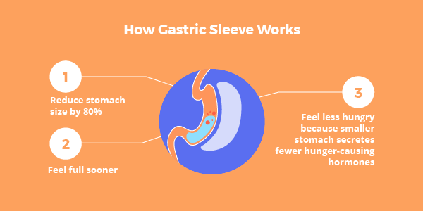 Bariatric Sleeve Weight Loss Chart